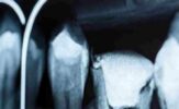 Endodontics_ A Tribute to Their Impact