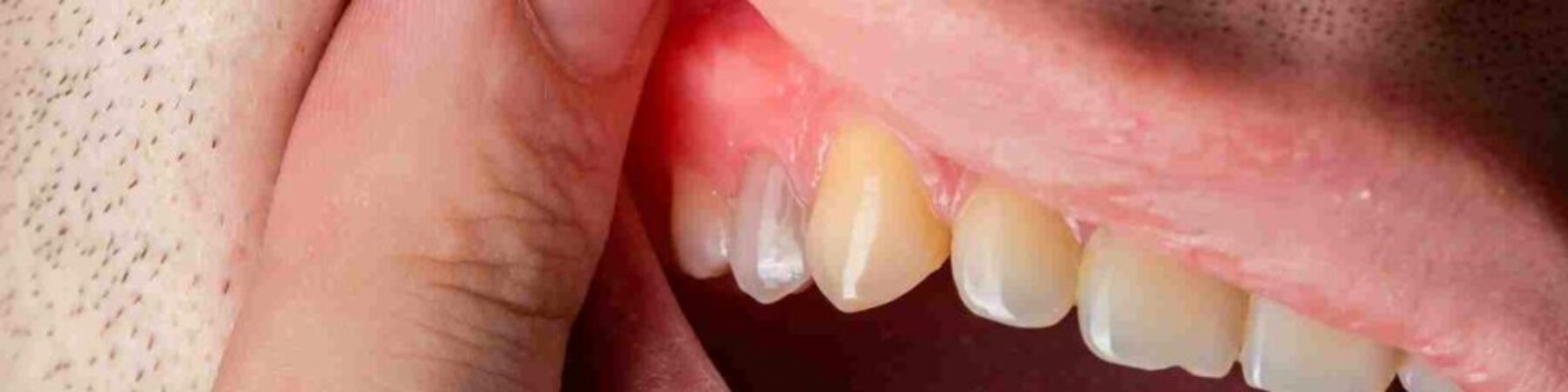 The Roots of Periodontics_ Types and Major Disorders Explored